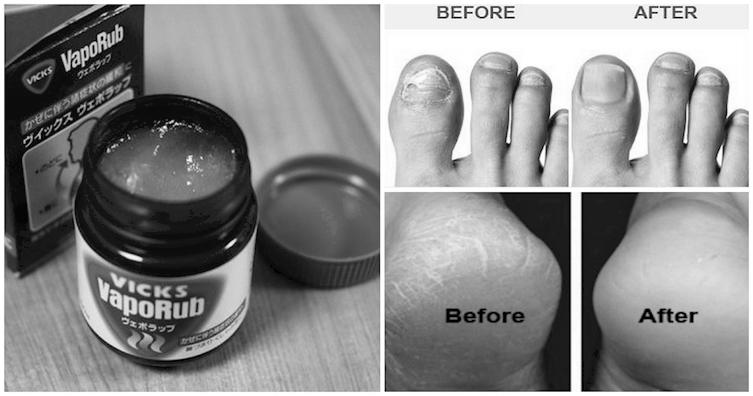 Does Vicks Vaporub really cure toenail fungus? photo 10