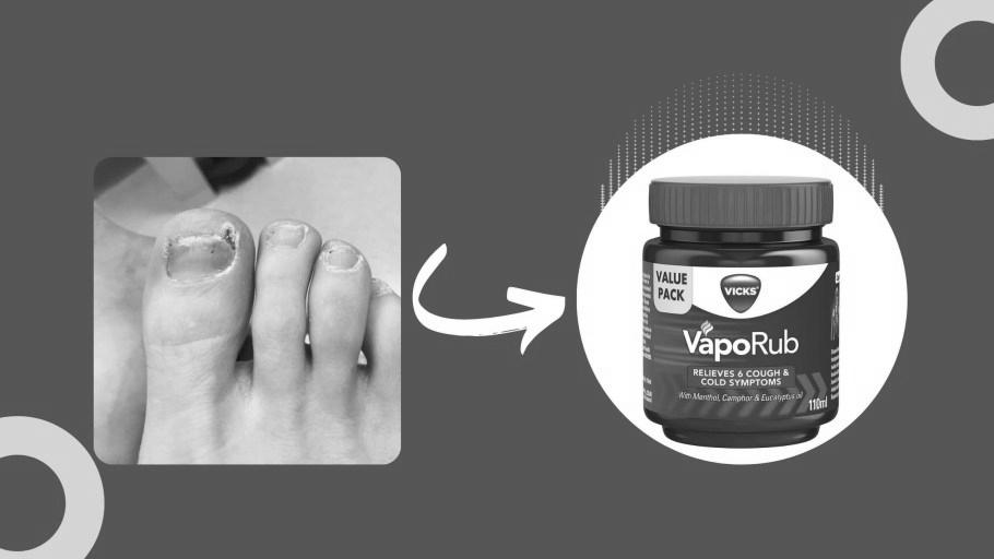 Does Vicks Vaporub really cure toenail fungus? photo 16