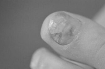 How are toenail fungus and type 2 diabetes related? image 0