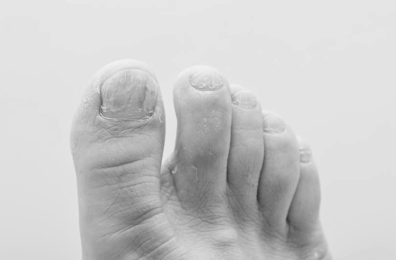 How are toenail fungus and type 2 diabetes related? image 2