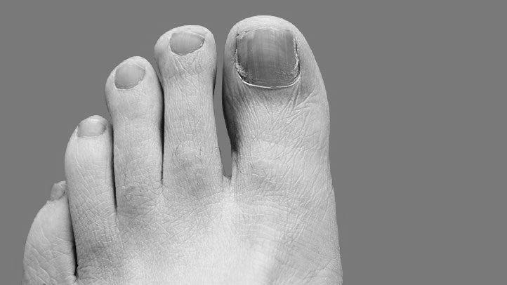 How are toenail fungus and type 2 diabetes related? image 6