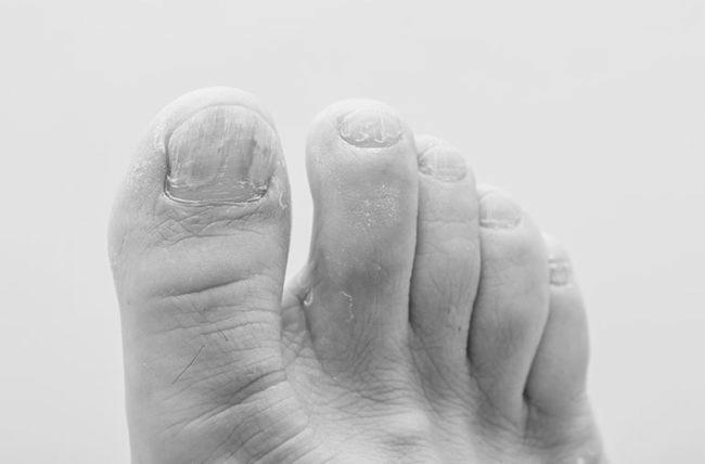 How are toenail fungus and type 2 diabetes related? image 7