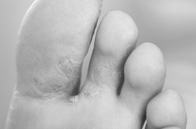 How are toenail fungus and type 2 diabetes related? image 9