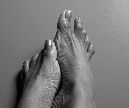 How are toenail fungus and type 2 diabetes related? image 14