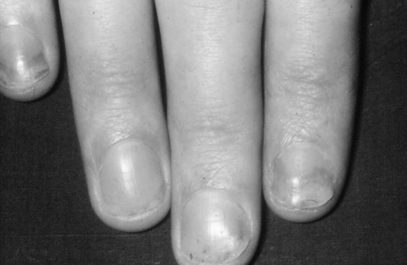 What is the best nail psoriasis treatment? photo 3
