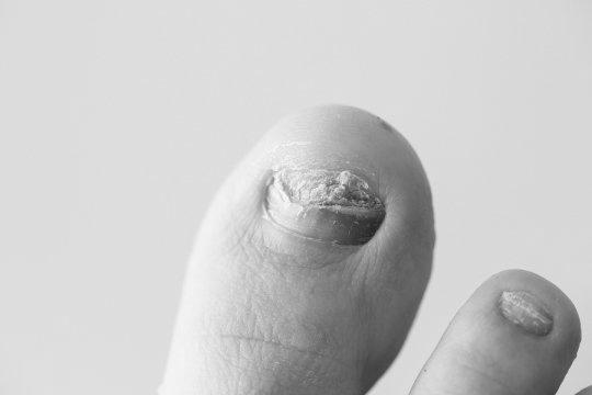 What is the best nail psoriasis treatment? photo 7