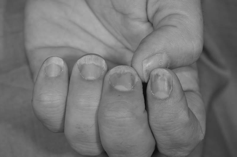 What is the best nail psoriasis treatment? photo 12