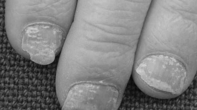 What is the best nail psoriasis treatment? photo 13
