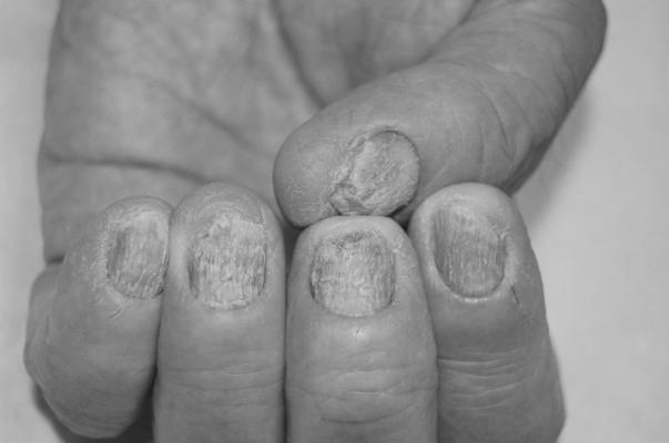What is the best nail psoriasis treatment? photo 17