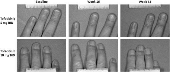 What is the best nail psoriasis treatment? image 3
