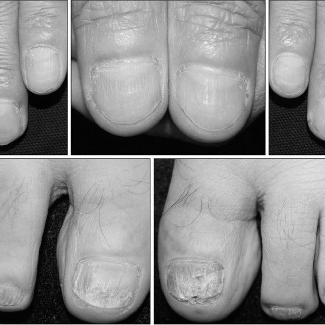 What is the best nail psoriasis treatment? image 0