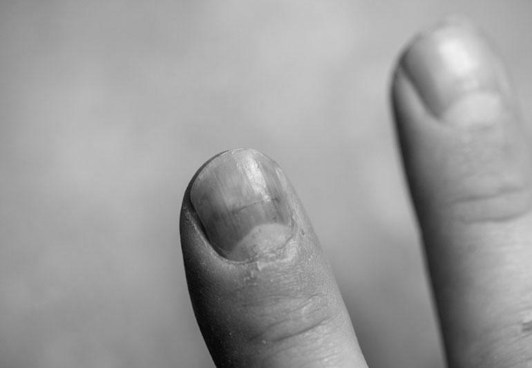 What are some possible reasons my fingernail hurts? photo 5