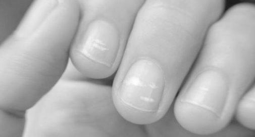 What do split fingernails indicate? image 17