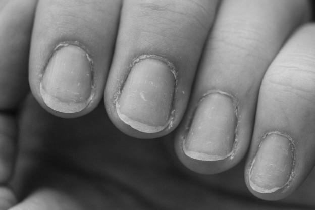 How to take care of brittle nails? photo 13