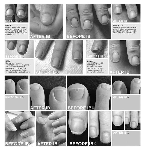 How can I treat paper thin fingernails? photo 4