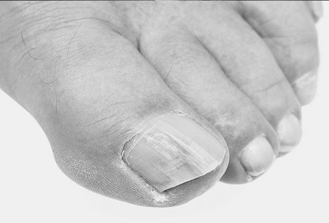 What can cause nails to become thick and ridged? image 1