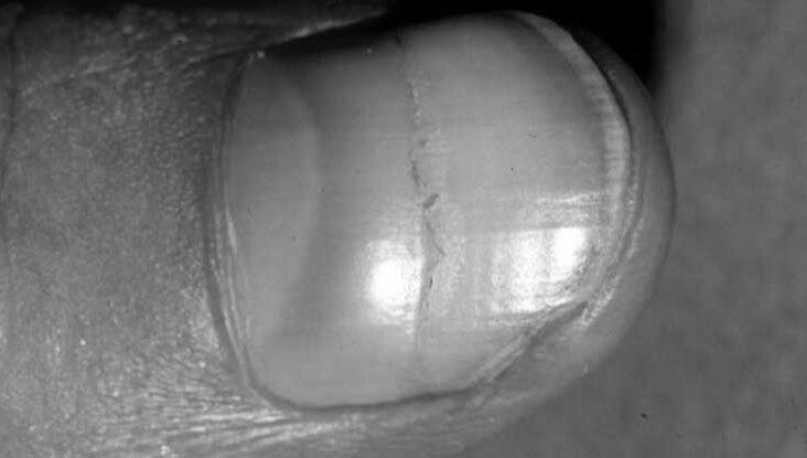 What can cause nails to become thick and ridged? image 10
