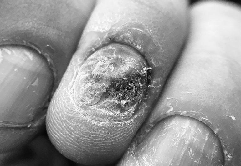 What can cause nails to become thick and ridged? image 14