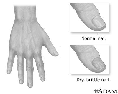 What can cause nails to become thick and ridged? image 2