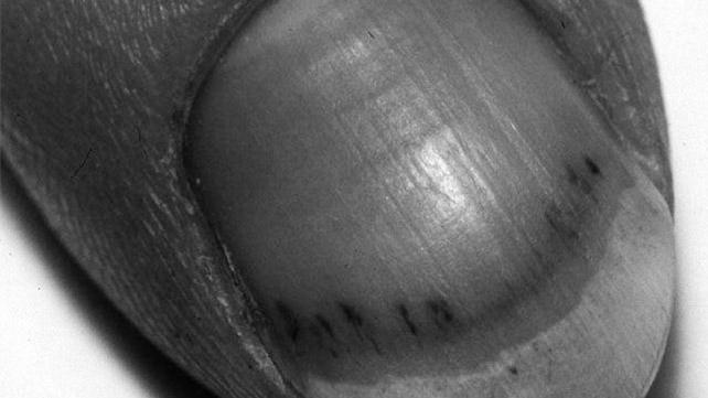 What causes black lines in nails? How can you treat it? image 6
