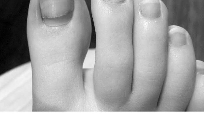 Why do some toenails have horizontal ridges? image 0