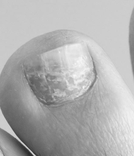 Why do some toenails have horizontal ridges? image 1