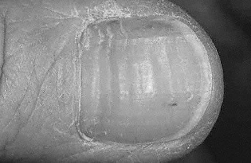 Why do some toenails have horizontal ridges? image 2