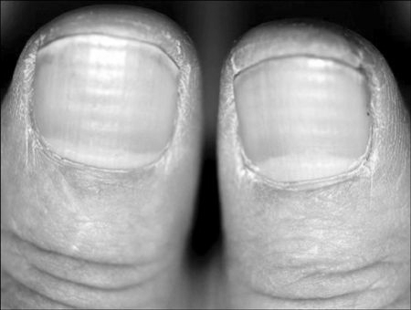 Why do some toenails have horizontal ridges? image 4