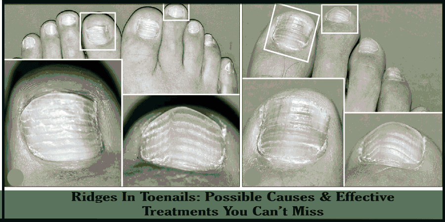 Why do some toenails have horizontal ridges? image 10