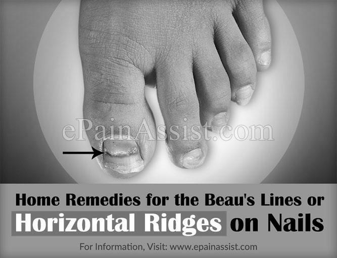 Why do some toenails have horizontal ridges? image 16