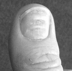 Why do some toenails have horizontal ridges? image 17