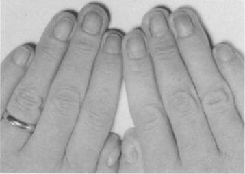 What is yellow nail syndrome? photo 1