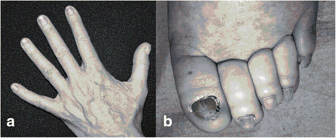 What is yellow nail syndrome? photo 3