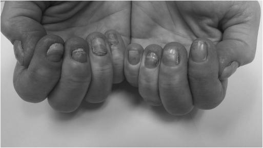 What is yellow nail syndrome? photo 4