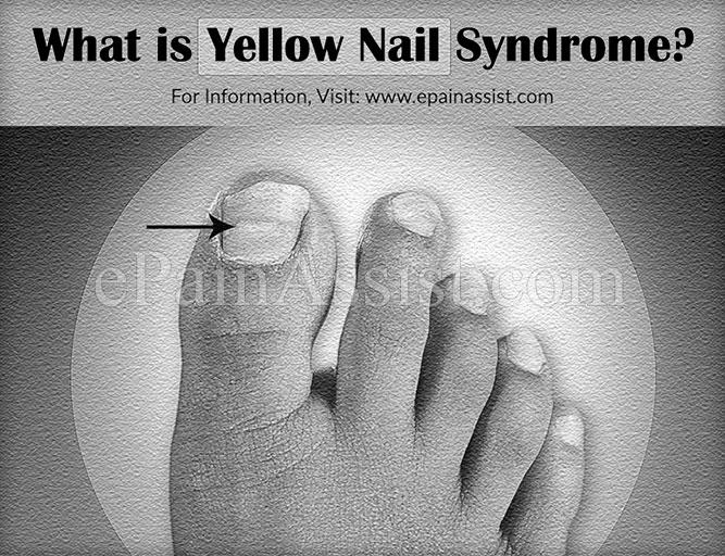 What is yellow nail syndrome? photo 5