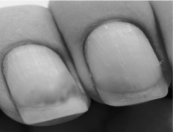 What is yellow nail syndrome? photo 6