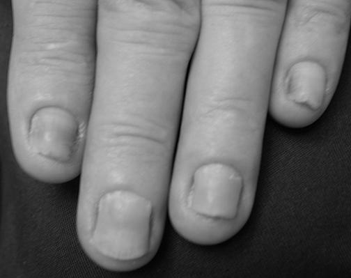 What is yellow nail syndrome? photo 10
