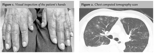 What is yellow nail syndrome? photo 12