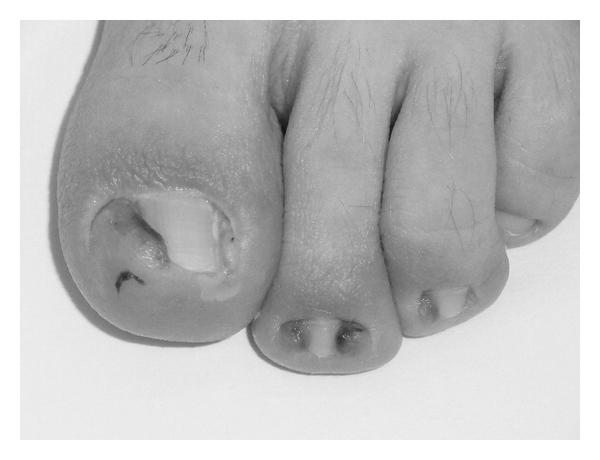 Will my ingrown toe nail recur? photo 5