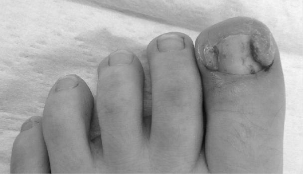 Will my ingrown toe nail recur? photo 6