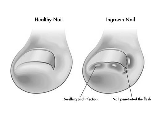 Will my ingrown toe nail recur? photo 10