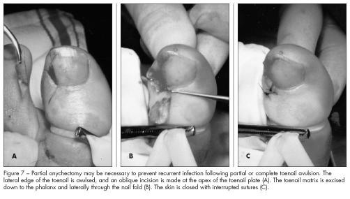 Will my ingrown toe nail recur? photo 13