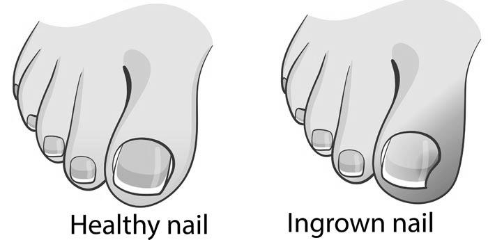 Will my ingrown toe nail recur? photo 0