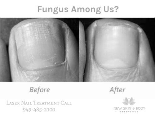 What is nail infection? photo 12