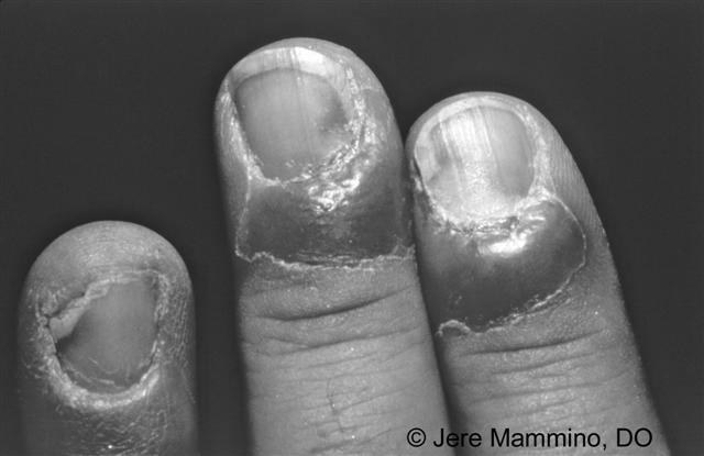 What is nail infection? photo 13