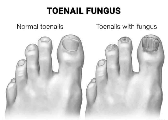 What is nail infection? photo 18