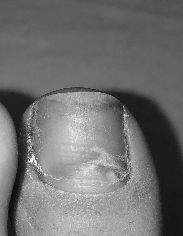 Why does the toenail crack, turn yellow, and get hollow? image 2