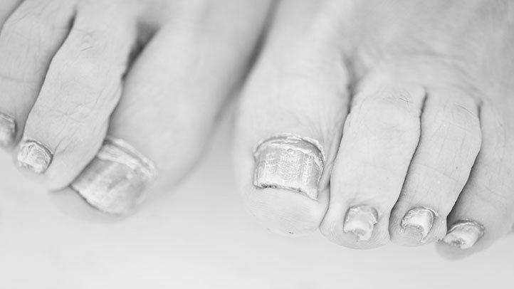 Why does the toenail crack, turn yellow, and get hollow? image 3