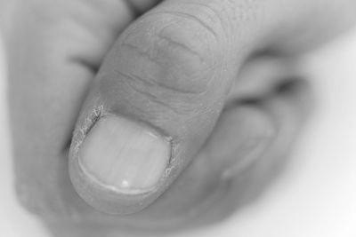 What is scaly and peeling nails a sign of? photo 15