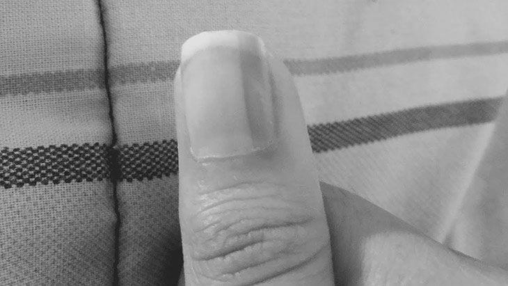 How do you remove black lines in the finger nails? photo 1